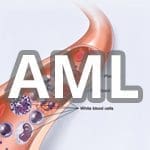 AML